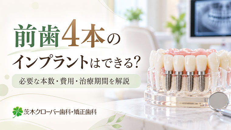 前歯4本のインプラントはできる？必要な本数・費用・治療期間を解説