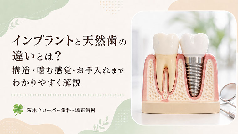 インプラントと天然歯の違いとは？構造・噛む感覚・お手入れまでわかりやすく解説