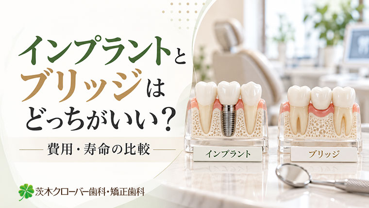 インプラントとブリッジはどっちがいい？費用・寿命・選び方を比較