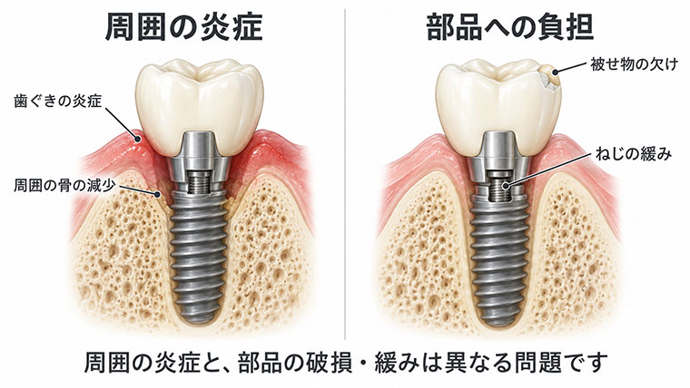 インプラントのトラブルの原因