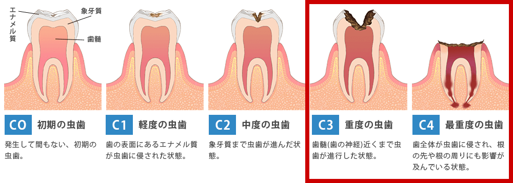 虫歯の進行