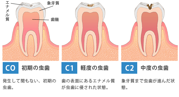 虫歯