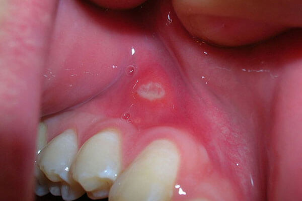 歯茎に出来た口内炎