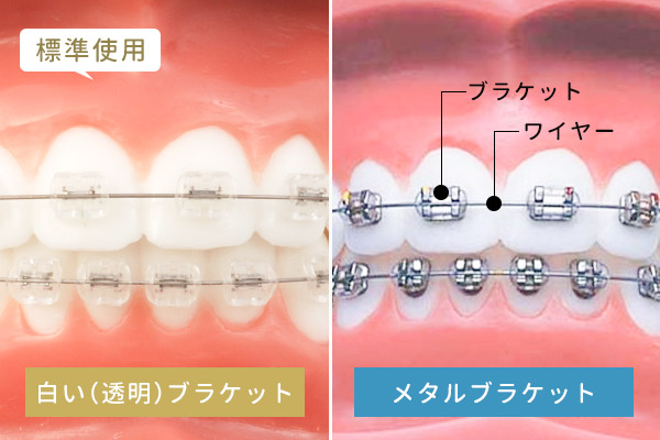ブラケットの比較