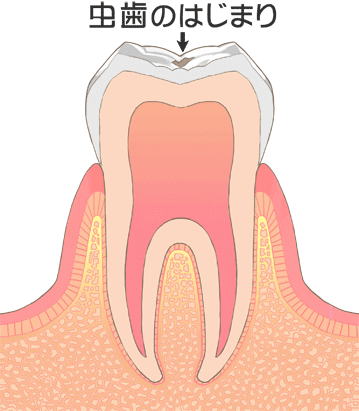 虫歯の進行：CO