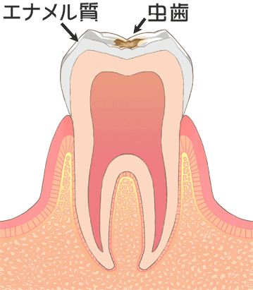 虫歯の進行：C1