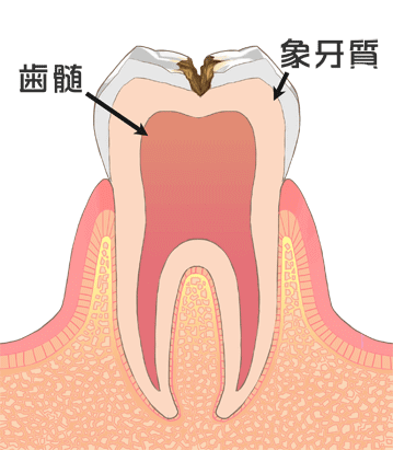 虫歯の進行：C2