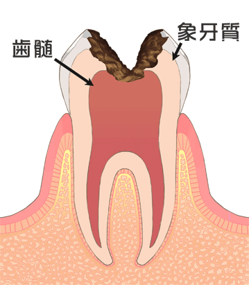 虫歯の進行：C3