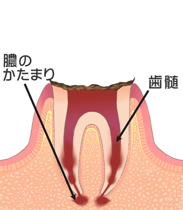 虫歯の進行：C4